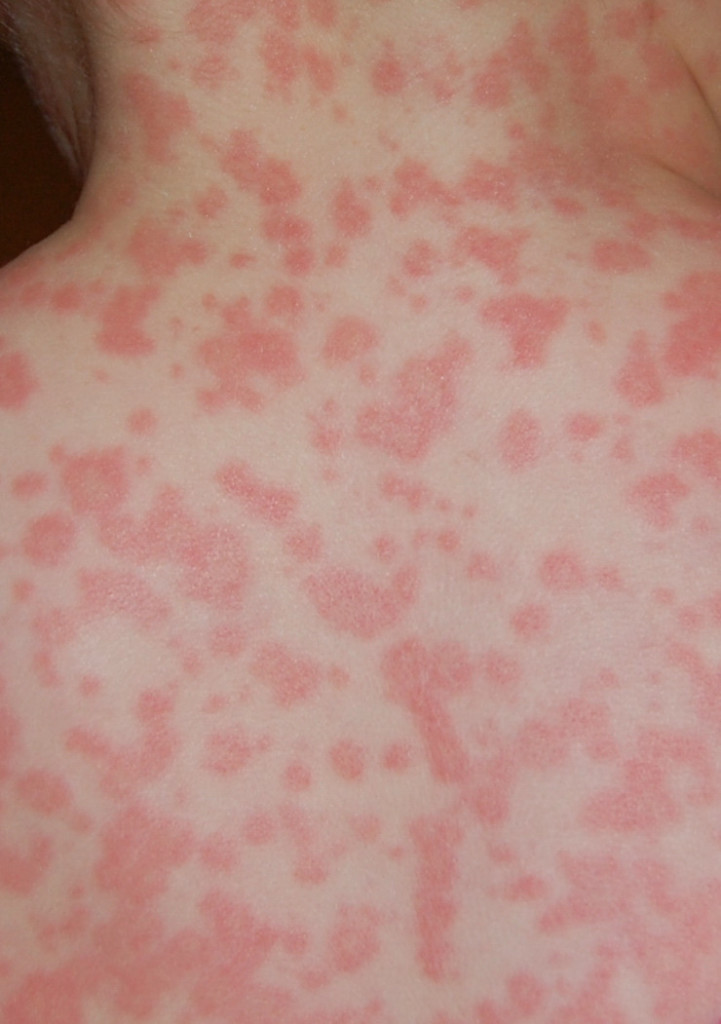 Diagnosed "amoxicillin rash". Shown approximately 11 hours after the 17th dose of 400 mg / ml oral suspension amoxicillin (Teva). Rash first noticed after 15th dose. Apparently not itchy. No blisters noticed. Began on trunk, spread to face, neck, head, ar