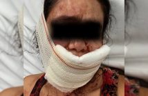 Mulher tem lábios arrancados com mordidas após rir do namorado
