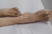 Idosa de 85 anos morre após ser abandonada desnutrida pelo filho advogado