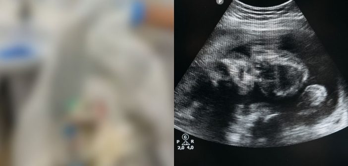 Jovem de 20 anos morre durante aborto clandestino em motel; casal é preso
